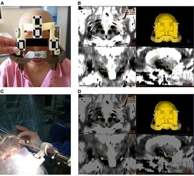 Application of the robot-assisted implantation in deep brain stimulation